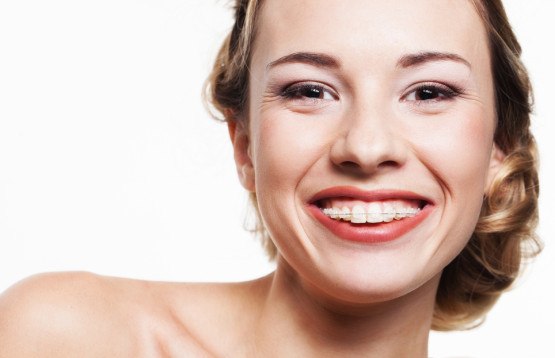 photodune-4465792-smile-with-dental-braces-s-555x358